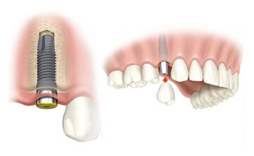 Slika implantata